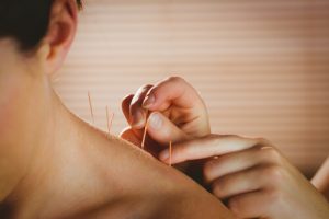 acupuncture therapy for woman